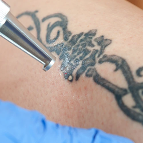Laser Tattoo Removal: Unlocking a Fresh Start with Precision